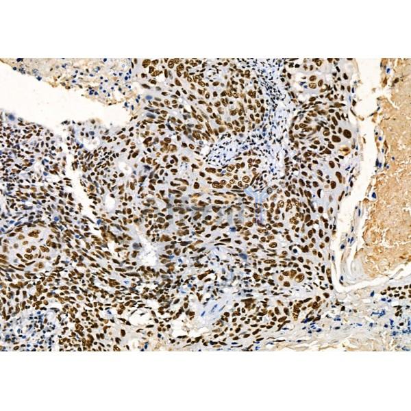 KAP1 Antibody - DF3150 at 1/100 staining Human pancreatic cancer by IHC-P.