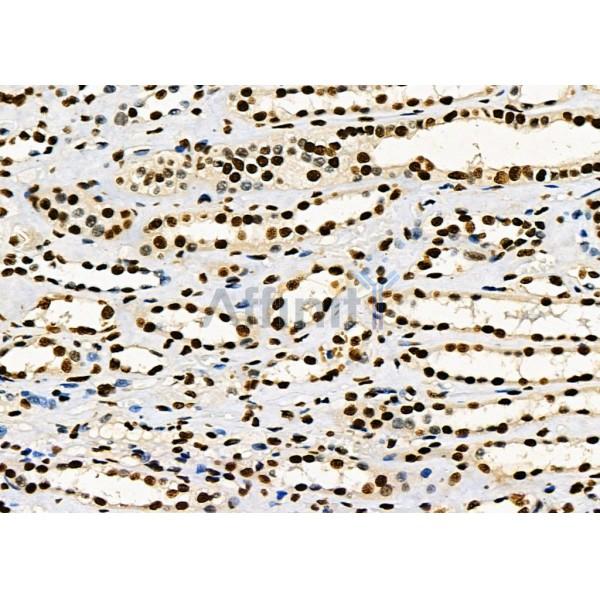 KAP1 Antibody - DF3150 at 1/100 staining Human kidney cancer and adjacent normal tissues by IHC-P.