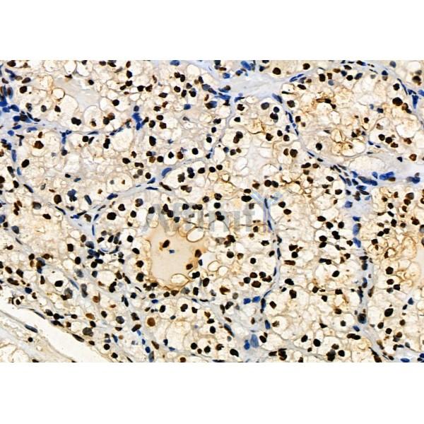 KAP1 Antibody - DF3150 at 1/100 staining Human kidney cancer by IHC-P.