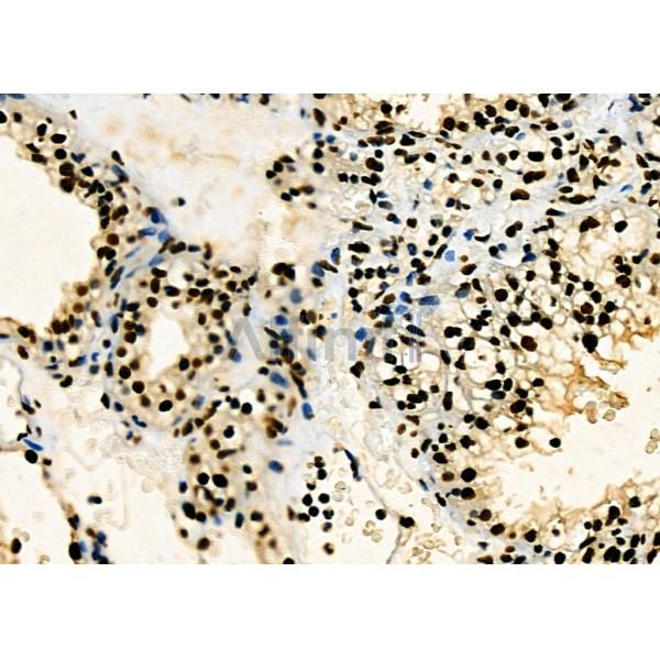 KAP1 Antibody - DF3150 at 1/100 staining Human ovarian cancer and adjacent normal tissues by IHC-P.