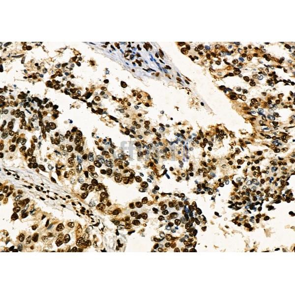 KAP1 Antibody - DF3150 at 1/100 staining Human ovarian cancer by IHC-P.
