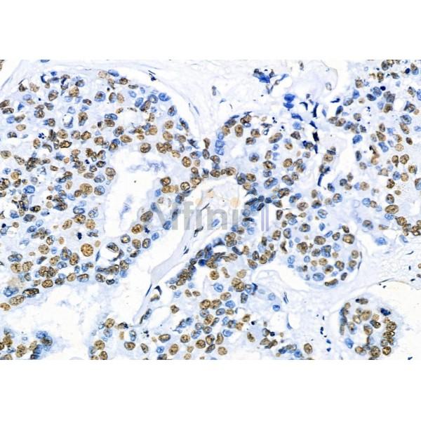 KAP1 Antibody - DF3150 at 1/100 staining Human mammary cancer by IHC-P.
