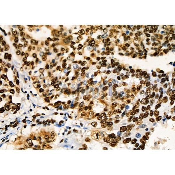 KAP1 Antibody - DF3150 at 1/100 staining human ovarian cancer by IHC-P.