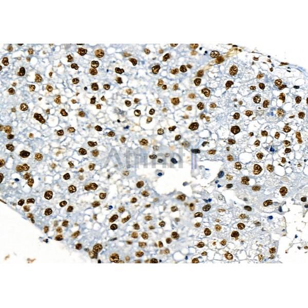 KAP1 Antibody - DF3150 at 1/100 staining Human liver cancer by IHC-P.