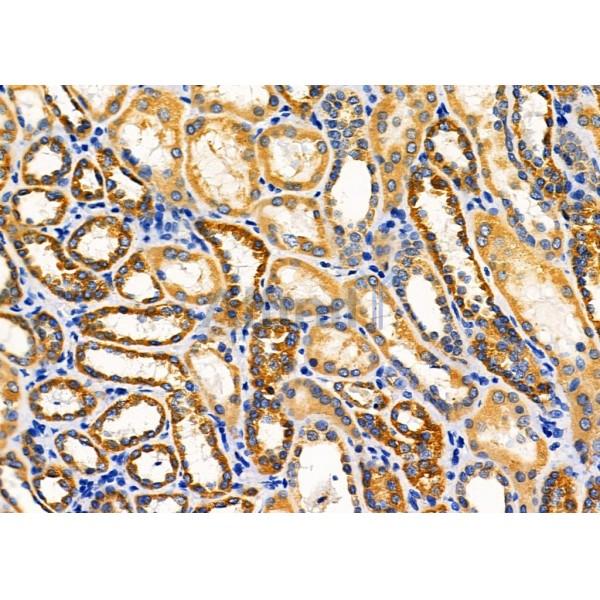 KCNK1 Antibody - DF4305 at 1/100 staining Human kidney cancer and adjacent normal tissues by IHC-P.