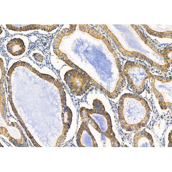 KCNK1 Antibody - DF4305 at 1/100 staining Human ovarian cancer by IHC-P.