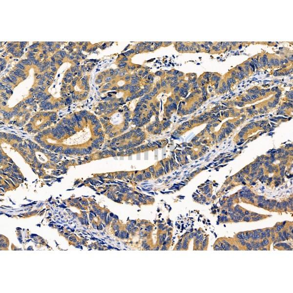 KCNK17 Antibody - DF4308 at 1/100 staining Human colorectal cancer by IHC-P.