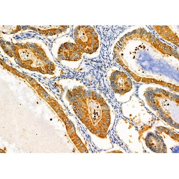 KCNK17 Antibody - DF4308 at 1/100 staining Human ovarian cancer by IHC-P.