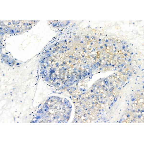 KCNK4 Antibody - DF4309 at 1/100 staining Human prostate cancer and adjacent normal tissues by IHC-P.