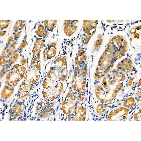 KCNK4 Antibody - DF4309 at 1/100 staining Human gastric cancer and adjacent normal tissues by IHC-P.