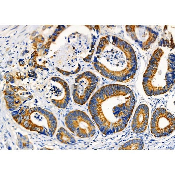 KCNK4 Antibody - DF4309 at 1/100 staining Human colorectal cancer by IHC-P.