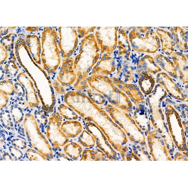 KCNK4 Antibody - DF4309 at 1/100 staining Human kidney cancer and adjacent normal tissues by IHC-P.