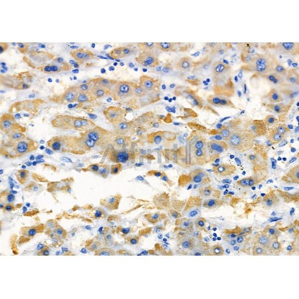 KCNK4 Antibody - DF4309 at 1/100 staining Human liver cancer by IHC-P.