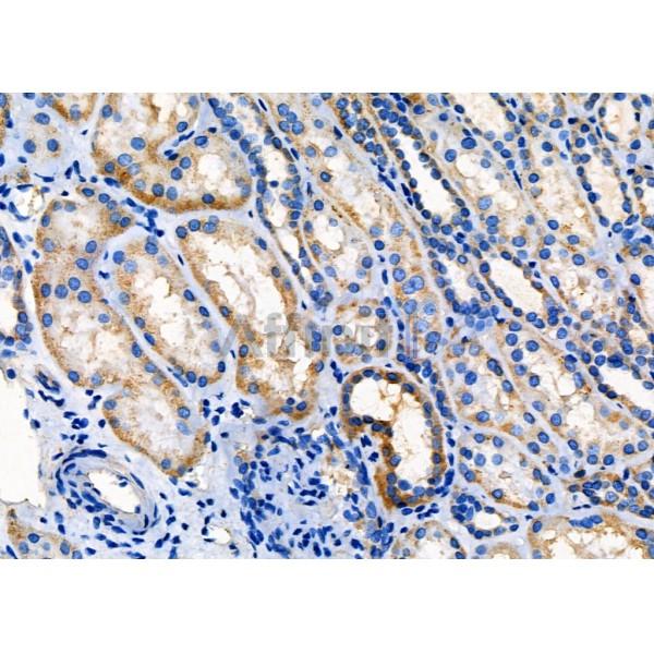 SPINK5 Antibody - DF4462 at 1/100 staining Human kidney cancer and adjacent normal tissues by IHC-P.