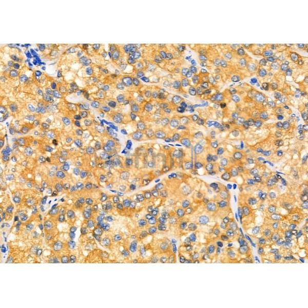 TBRG4 Antibody - DF6079 at 1/100 staining Human kidney cancer by IHC-P.