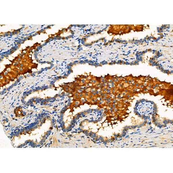 SERPINA1 Antibody - DF6182 at 1/100 staining Human colorectal cancer by IHC-P.