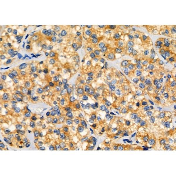 ARPC1A Antibody - DF6215 at 1/100 staining Human kidney cancer by IHC-P.