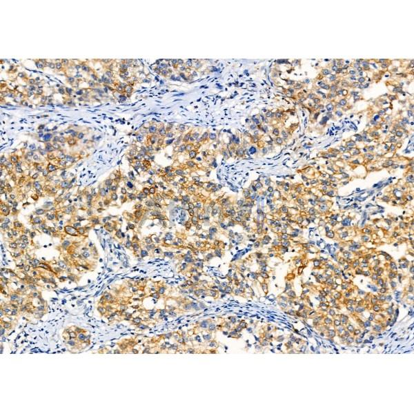 TPM3 Antibody - DF6338 at 1/100 staining Human pancreatic cancer by IHC-P.