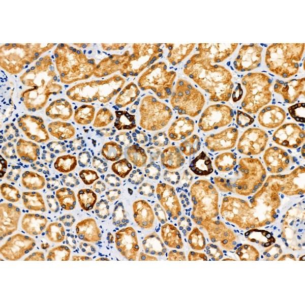 TPM3 Antibody - DF6338 at 1/100 staining Human kidney cancer and adjacent normal tissues by IHC-P.