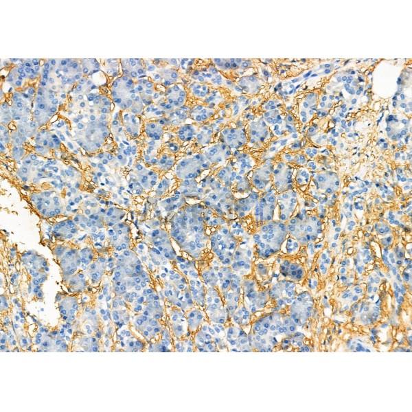 CST8 Antibody - DF6356 at 1/100 staining Human pancreatic cancer and adjacent nomal tissues by IHC-P.