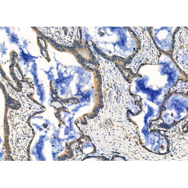 Cholinesterase/BCHE Antibody - DF6419 at 1/100 staining Human colorectal cancer by IHC-P.