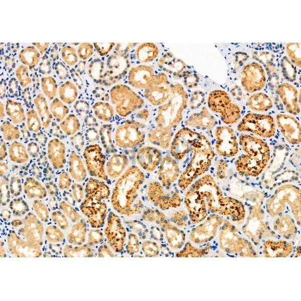 PICK1 Antibody - DF6438 at 1/100 staining Human kidney cancer and adjacent normal tissues by IHC-P.