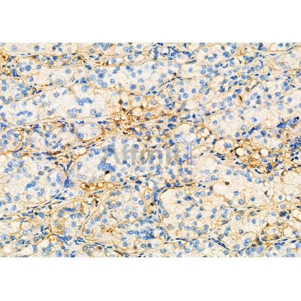 AHSG Antibody - DF6528 at 1/100 staining Human kidney cancer by IHC-P.