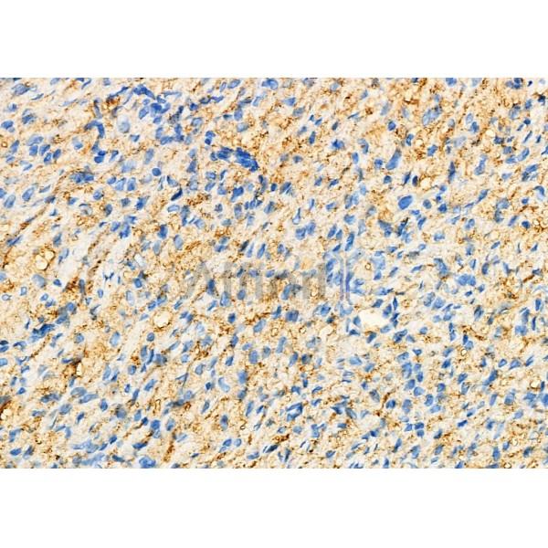 AHSG Antibody - DF6528 at 1/100 staining Human ovarian cancer and adjacent normal tissues by IHC-P.