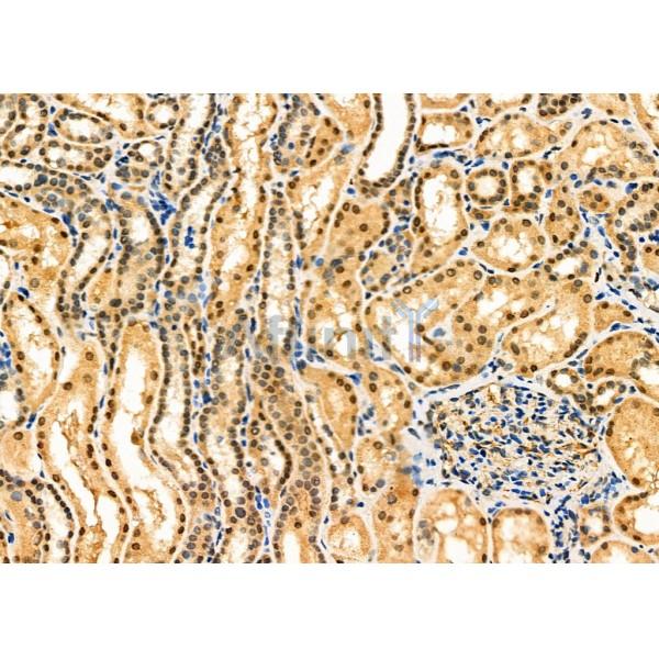 COPS5 Antibody - DF6602 at 1/100 staining Human kidney cancer and adjacent normal tissues by IHC-P.
