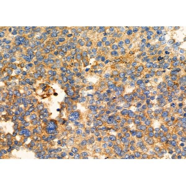 EBAG9 Antibody - DF6703 at 1/100 staining Human ovarian cancer by IHC-P.