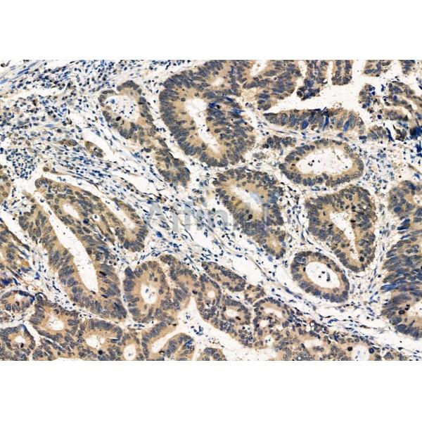 TOR1A Antibody - DF6796 at 1/100 staining Human prostate cancer by IHC-P.