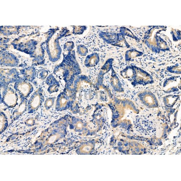 GNA15 Antibody - DF6805 at 1/100 staining Human colorectal cancer by IHC-P.