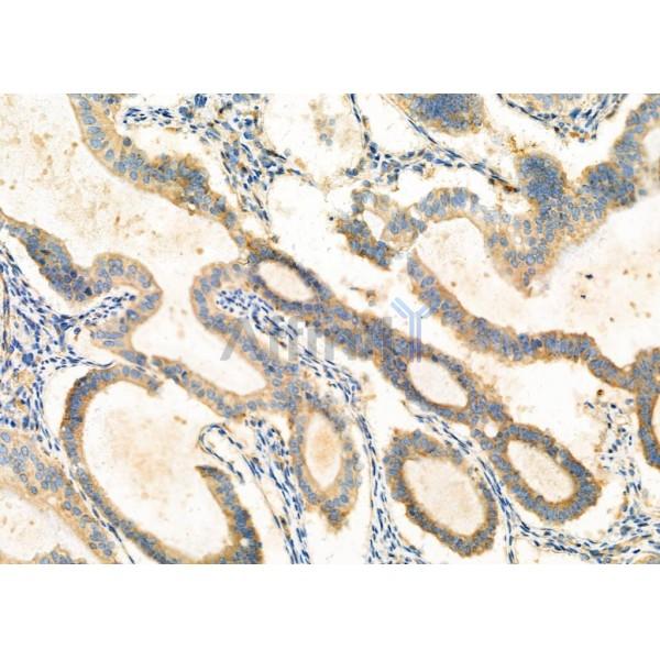 GNA15 Antibody - DF6805 at 1/100 staining human ovarian cancer by IHC-P.