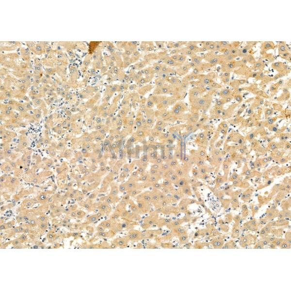 IL1RN Antibody - DF6812 at 1/100 staining Human liver cancer and adjacent normal tissues by IHC-P.