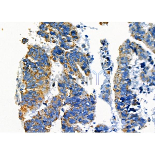 SPDYA Antibody - DF6876 at 1/100 staining Human colorectal cancer by IHC-P.