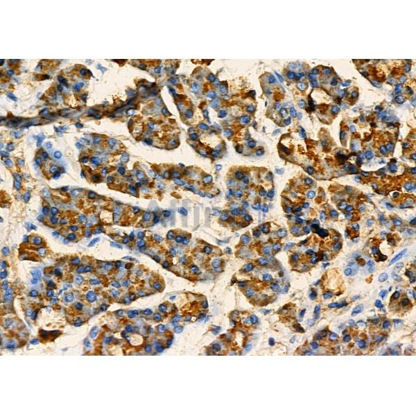 CLEC4A Antibody - DF7061 at 1/100 staining Human pancreatic cancer and adjacent nomal tissues by IHC-P.