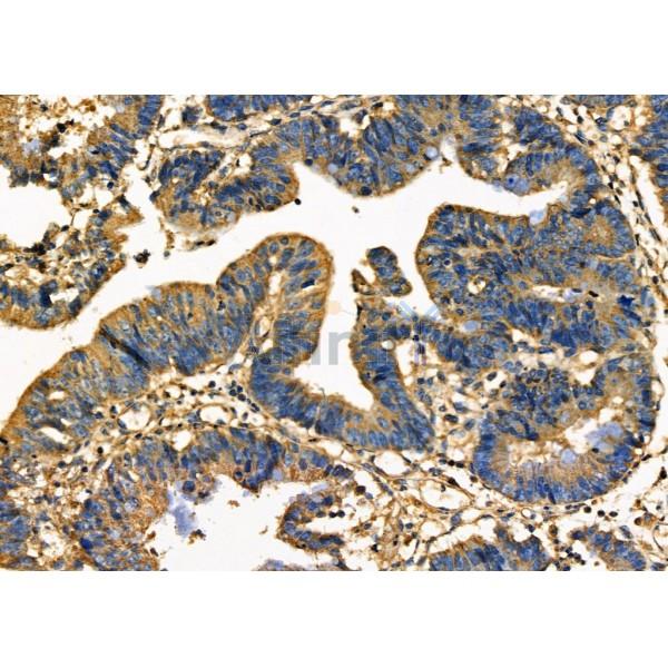PDCD10 Antibody - DF7080 at 1/100 staining Human colorectal cancer by IHC-P.