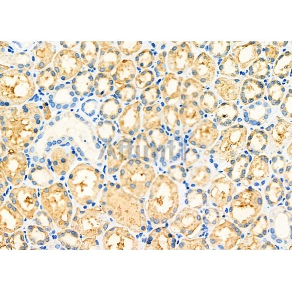 LRPAP1 Antibody - DF7141 at 1/100 staining Human kidney cancer and adjacent normal tissues by IHC-P.