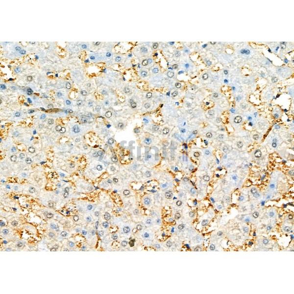 LRPAP1 Antibody - DF7141 at 1/100 staining Human liver cancer and adjacent normal tissues by IHC-P.