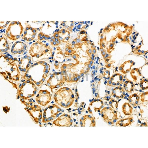 SLC1A4 Antibody - DF7178 at 1/100 staining Human kidney cancer and adjacent normal tissues by IHC-P.