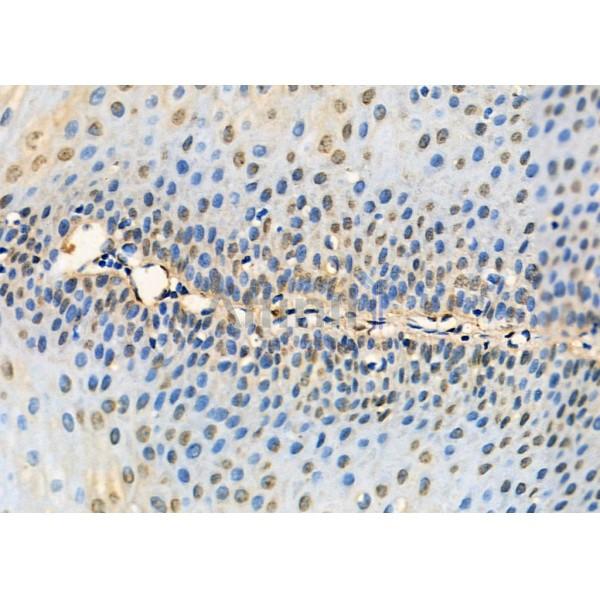 Nono Antibody - DF7254 at 1/100 staining Human esophageal cancer and adjacent normal tissues by IHC-P.