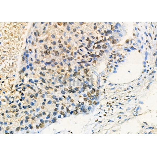 Nono Antibody - DF7254 at 1/100 staining Human esophageal cancer by IHC-P.