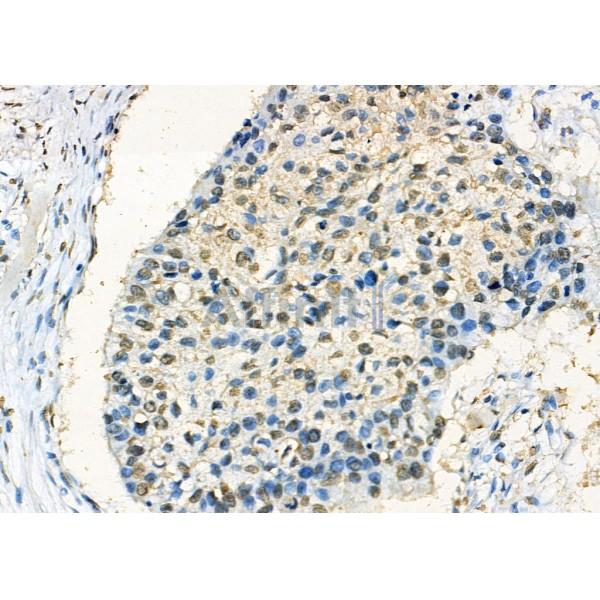 Nono Antibody - DF7254 at 1/100 staining Human esophageal cancer by IHC-P.