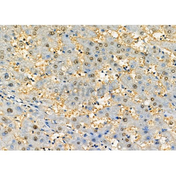 Nono Antibody - DF7254 at 1/100 staining Human liver cancer by IHC-P.