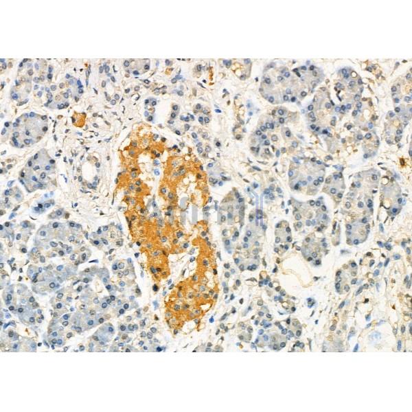 C10orf2 Antibody - DF7263 at 1/100 staining Human pancreatic cancer and adjacent nomal tissues by IHC-P.