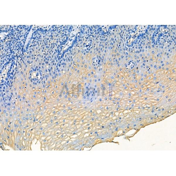 NUDT1 Antibody - DF7359 at 1/100 staining Human esophageal cancer and adjacent normal tissues by IHC-P.