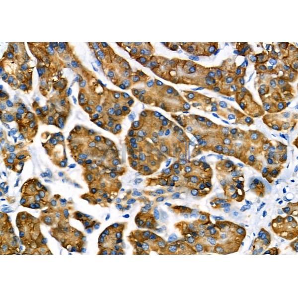 NUDT1 Antibody - DF7359 at 1/100 staining Human pancreatic cancer and adjacent nomal tissues by IHC-P.