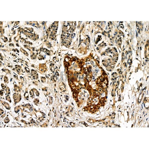 PSRC1 Antibody - DF7366 at 1/100 staining Human pancreatic cancer and adjacent nomal tissues by IHC-P.