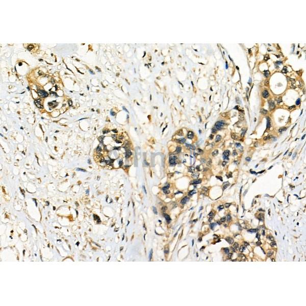 Rabl2 Antibody - DF7408 at 1/100 staining Human pancreatic cancer by IHC-P.
