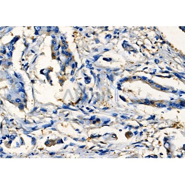 SIX2 Antibody - DF7583 at 1/100 staining Human colorectal cancer by IHC-P.